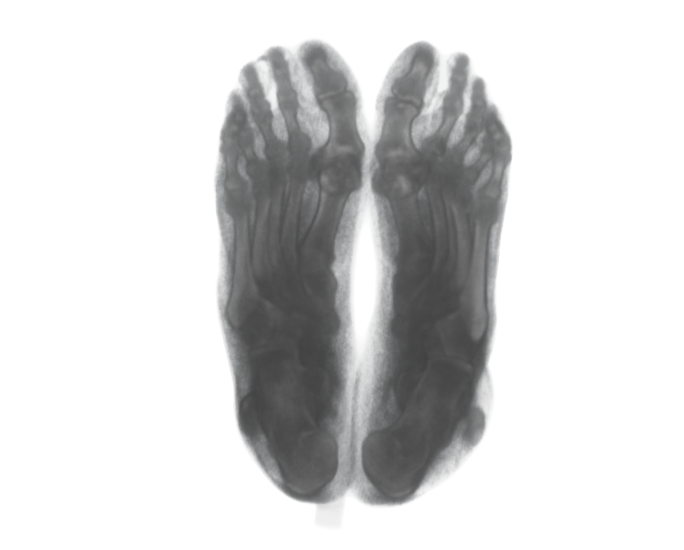 Bottom-view CT scan of the printed and scanned feet phantom