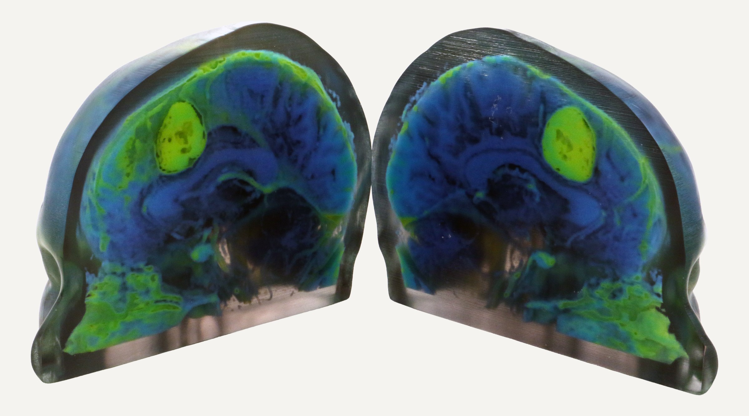 Photograph of two printed halves of a brain scan. Tissue appears in blues and greens, and an oval tumor in yellow-green is visible in each half.