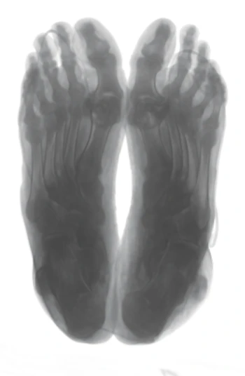 Gray CT image of a pair of feet seen from below, from the original scan.