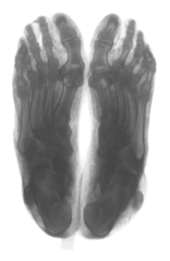 Gray CT image of the printed phantom seen from below, showing a similar arrangement of bones.